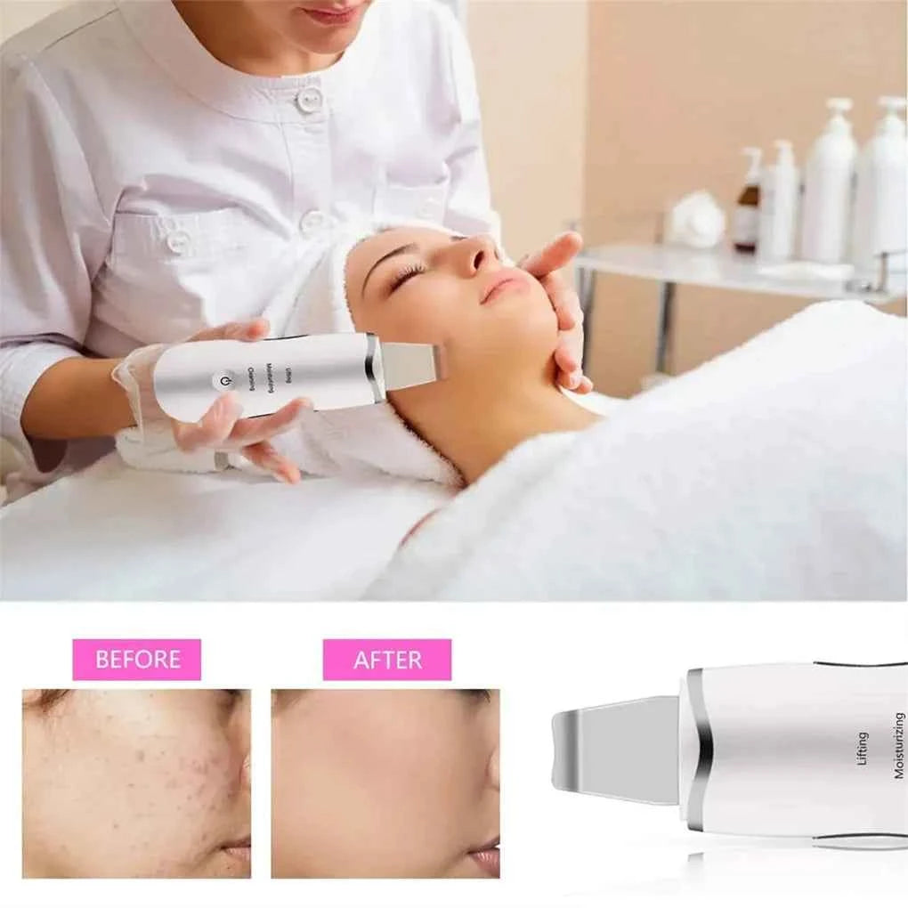 Ultrasonic Facial Cleanse Exfoliate Rejuvenate