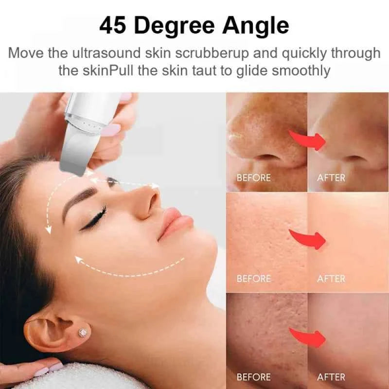 Ultrasonic Skin Spatula Clean Exfoliate Rejuvenate Your Skin