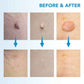 2in1 Skin Tag Remover Easy Portable Effective