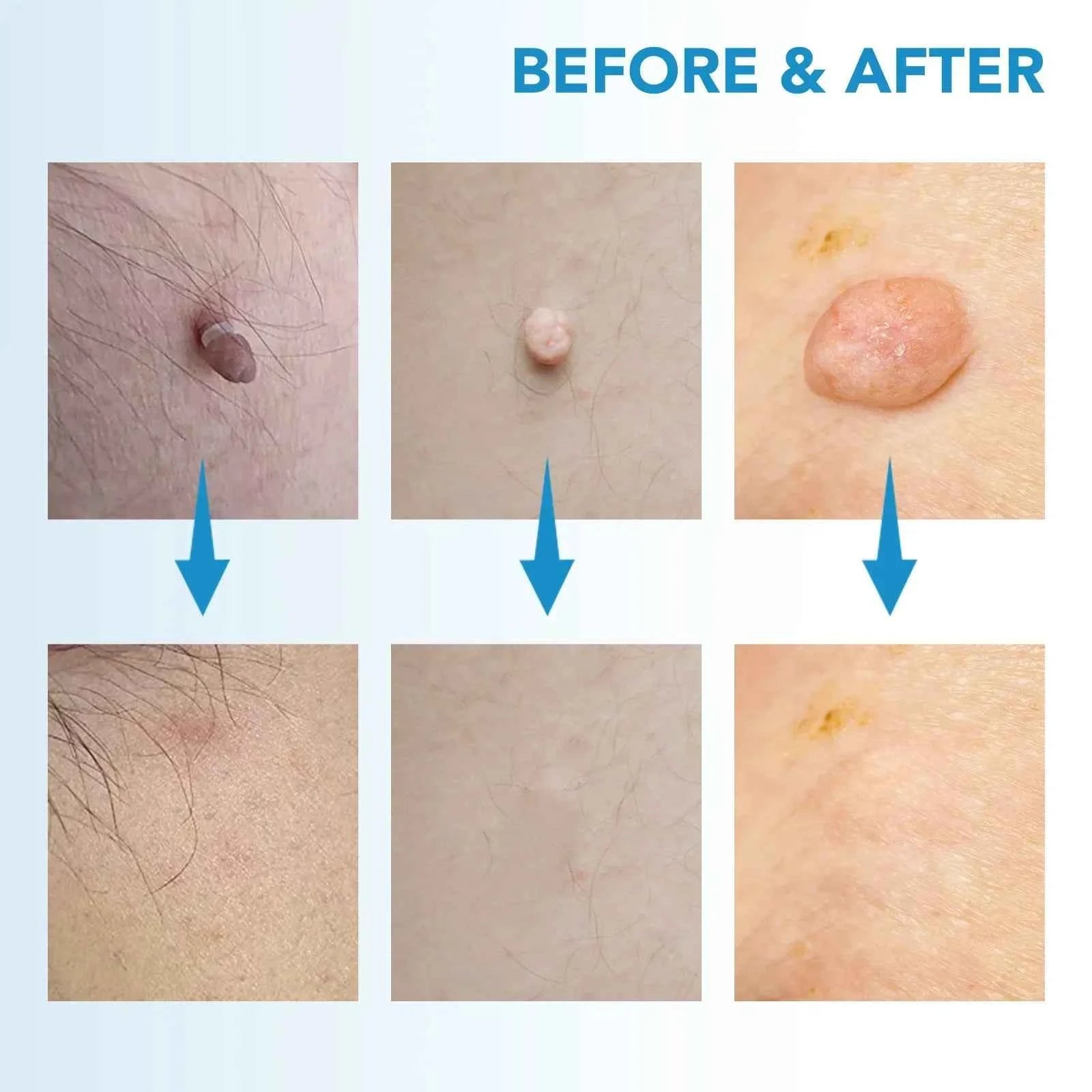 2in1 Skin Tag Remover Easy Portable Effective