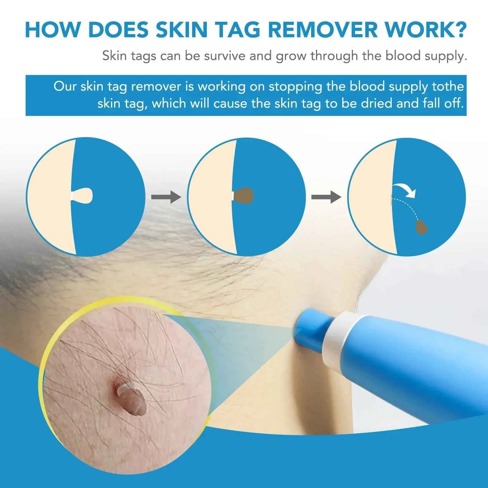 2in1 Skin Tag Remover Easy Portable Effective